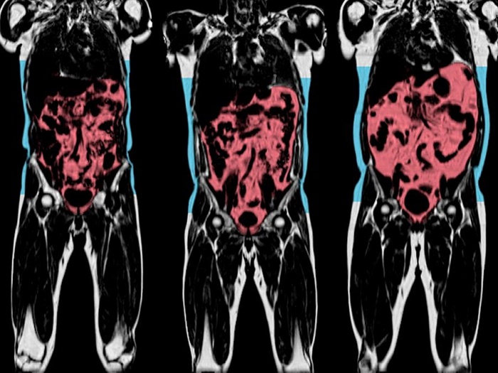 World`s largest human scanning project raises hope of treating diseases before they happen